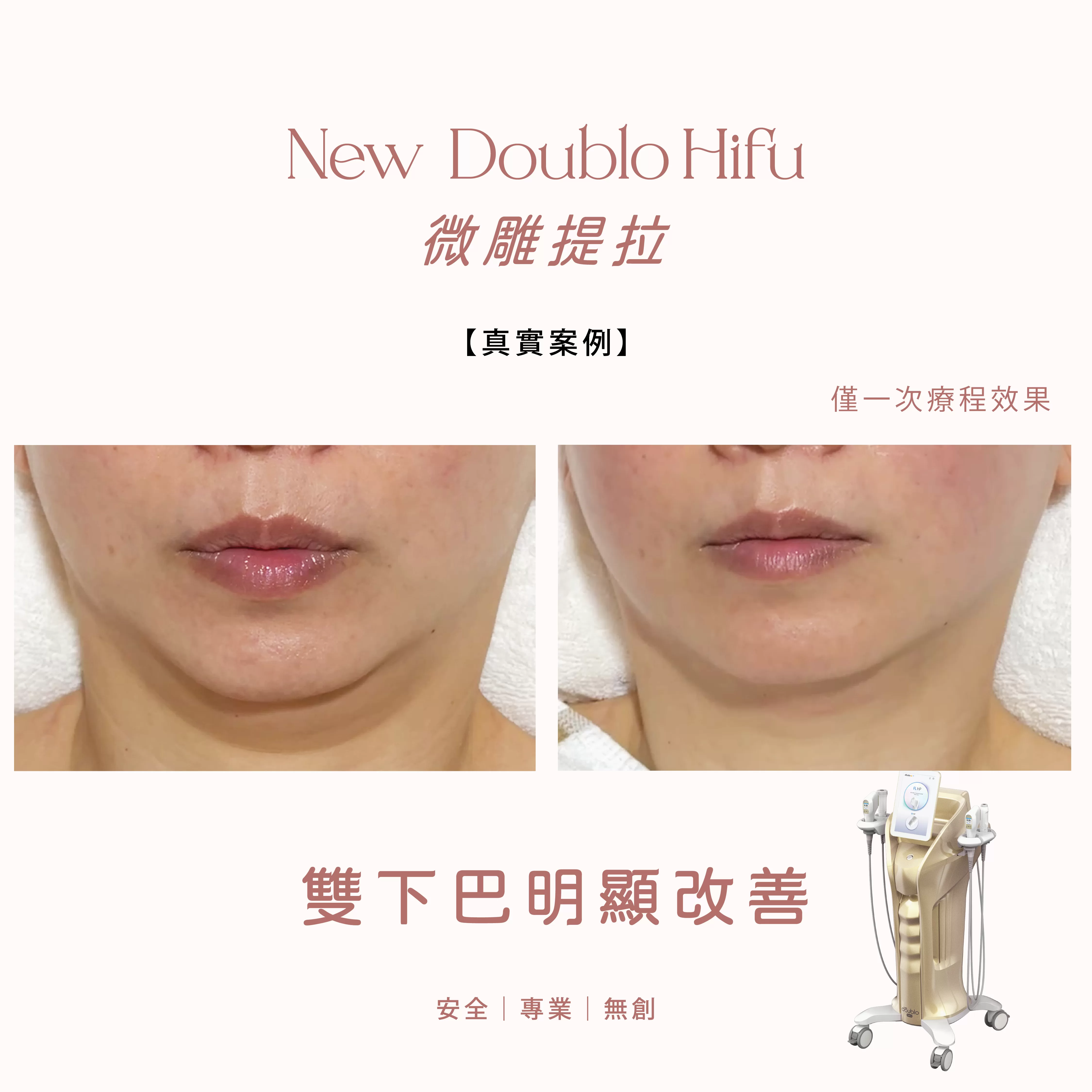 Before and after hifu-02